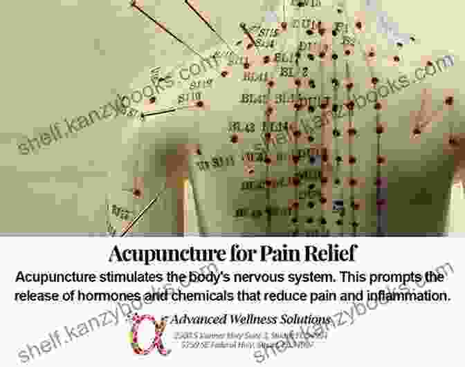 Acupuncture For Pain Relief A Primer On Medical Acupuncture